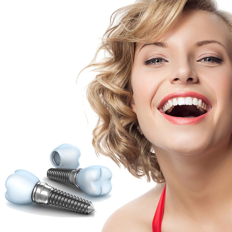 implanturi dentare