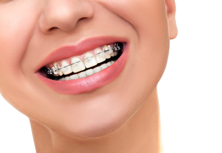 Pot fi efectuate tratamentele de canal atunci când porți aparat dentar? 3 Pot fi efectuate tratamentele de canal atunci când porți aparat dentar