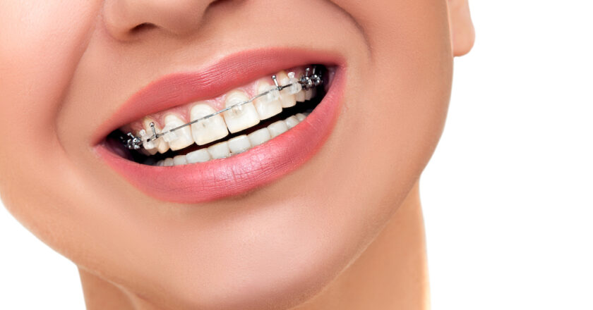 Pot fi efectuate tratamentele de canal atunci când porți aparat dentar