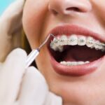 aparat dentar