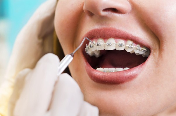 Cum sa alegem cel mai potrivit tip de aparat dentar? 1 aparat dentar