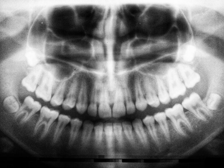 implant dentar